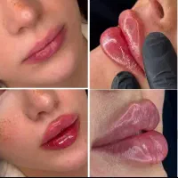 ژل و بوتاکس و لیزر در مطب با قیمت استثنایی