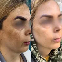 مدل جهت کار درمان تلفیقی پوست|خدمات آرایشگری و زیبایی|چالوس, |دیوار