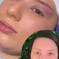 آموزش بلفاروپلاستی.جراحی لیفت ابرو. کاشت مو.