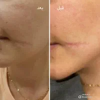 آموزش مزو نیدلینگ +تکنیک پوست کره ای+کاموفلاژ بدن|خدمات آموزشی|مشهد, هنرستان|دیوار