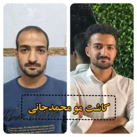 کاشت مو ،ابرو و ریش در شیراز|خدمات آرایشگری و زیبایی|کازرون, |دیوار