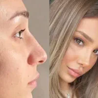 جراحی عمل بینی۱۰ ملیون تخفیف  لیفت،لیپو ابدو