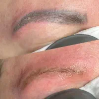 تخفیف 50% ریمو تتو ابرو با لیزر
