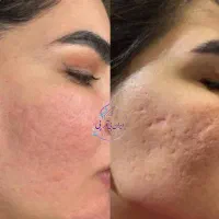 پی ارپی مزوژل مزونیدلینگ سابسیژن لک جای جوش اسکار