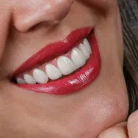 جشنواره کامپوزیت لمینیت روکش عصب ونیر بریدج ترمیم