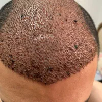 کاشت مو.ابرو.ریش درکیلنیک تخصصی|خدمات آرایشگری و زیبایی|قم, باجک دو|دیوار