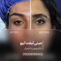 جراحی پلک و بلفاروپلاستیVIP با بخیه لیزری