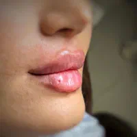 جشنواره  پی آرپی ژل و بوتاکس مزوتراپی بلفارو