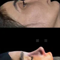 عمل جراحی بینی بلفارروتو جشنواره با زمان محدود