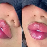 جشنواره تابستانه فیلر بوتاکس مزو‌ بادی از ۱۸۰ هزار|خدمات آرایشگری و زیبایی|محمدشهر, محمدشهر|دیوار