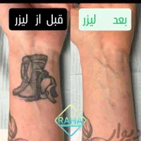 کلینیک پاک کردن تاتو(لیزرتضمینی)دریک جلسه/ریموابرو|خدمات آرایشگری و زیبایی|مشهد, احمدآباد|دیوار