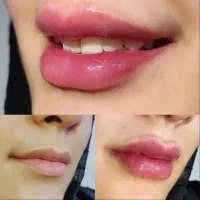 تخفیف ویژه فیلر هر سی سی ۸۵۰هزارتومان اصلی تضمینی