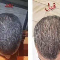 دمنوش های گیاهی ویژه مریضی های خاص و رفع کچلی