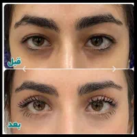 کاشت مو ابرو/بلفاروپلاستی/لیفت دایرکت ابرو/غبغب
