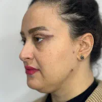 جشنواره بلفاروپلاستی جراحی پلک با بخیه لیزری|خدمات آرایشگری و زیبایی|تهران, شهرک غرب|دیوار