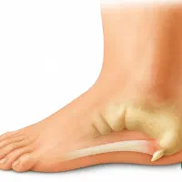 درمان تضمینی خارپاشنه