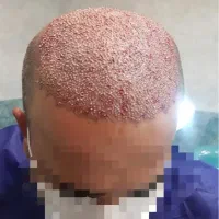 کاشت مو کامل فقط۱۸      کاشت ابرو فقط ۱۲