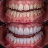 دندانپزشکی ونیر کامپوزیت و لمینت با شرایط پرداخت|خدمات آرایشگری و زیبایی|اصفهان, احمدآباد|دیوار