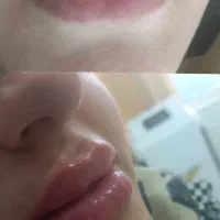 لیزر ژل وبوتاکس وخالبرداری سم زدایی|خدمات آرایشگری و زیبایی|تبریز, |دیوار