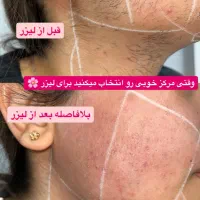 لیزر موهای زائد|خدمات آرایشگری و زیبایی|شهرضا, |دیوار