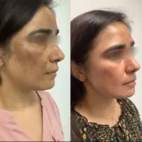 کرم سفید کننده شب (آنتی استاین )ترکیب آمپولی|آرایشی، بهداشتی، درمانی|بم, |دیوار