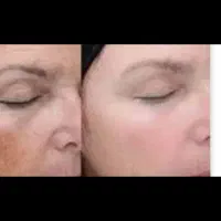 برداشتن انواع خال لک زیگیل تناسلی و...|خدمات زیبایی و سلامت|اصفهان, شهرک کوثر|دیوار