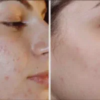 انجام خدمات مزوتراپی و مزوندیلینگ|خدمات آرایشگری و زیبایی|بوشهر, |دیوار