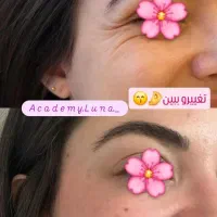ژل بوتاکس|خدمات آرایشگری و زیبایی|قم, بکایی|دیوار