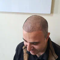 کاشت موی تخصصی و تضمینی|خدمات آرایشگری و زیبایی|تبریز, |دیوار