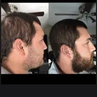 ریزش مو/رویش مجدد/رشد قدی مو /درمان کم پشتی مو