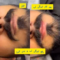 رفع تیرگی لب،شیدینگ کاموفلاژ بدن اسکالپ سر آقایان