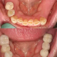 دندان مصنوعی قالب گیری در منزل|خدمات آرایشگری و زیبایی|کرج, کوی امامیه|دیوار