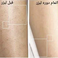 لیزر موهای زائد حتی برا اونایی که جواب نگرفتن