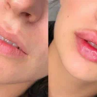 ژل لب روسی مادلینگ عربی زاویه سازی بوتاکس بادی|خدمات آرایشگری و زیبایی|تهران, سعادت‌آباد|دیوار