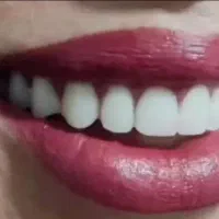 دندان مصنوعی یک روزه اقساط