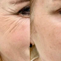 اموزش. بوتاکس فول فیس چشم گربه ای لیفت شقیقه|خدمات آرایشگری و زیبایی|خرم‌آباد, |دیوار