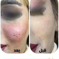 جشنواره تزریق ژل ۳۸۰ هزاروبوتاکس توسط کادردرمان|خدمات آرایشگری و زیبایی|اندیمشک, |دیوار