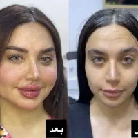 جشنواره  تزریق ژل  لب روسی وبوتاکس انزیم فیلر