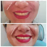 مدل بوتاکس ژل مزوتراپی میکرونیدلینگ فشیال