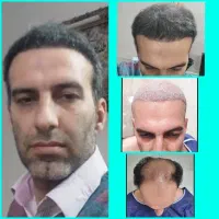 کاشت مو توسط تکنسین شیرازی در یزد|خدمات آرایشگری و زیبایی|یزد, |دیوار