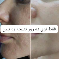 میخوای ۳روزه صورتت و بدنت سفید برفی شه ای کرم بزن|خدمات آرایشگری و زیبایی|ایذه, |دیوار