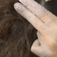 فشیال، خال‌برداری و کربوکسی با دستگاه