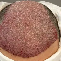 کاشت مو و ابرو و ریش تخصصی اقساطی در تهران