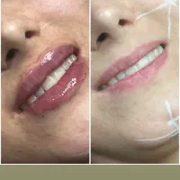 بوتاکس،فیلر توسط پزشک پوست و زیبایی(تخفیف استثنایی|خدمات آرایشگری و زیبایی|تهران, دروس|دیوار