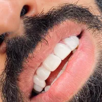 تخفیف ویژه کامپوزیت به مدت یک هفته|خدمات آرایشگری و زیبایی|اهواز, زیباشهر|دیوار