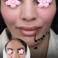 فیلر و بوتاکس وانزیم فیلر|خدمات آرایشگری و زیبایی|قم, دروازه چوبی|دیوار