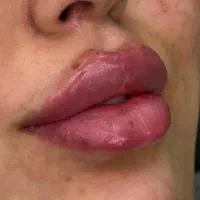 ژل فیلر بوتاکس آفر ویژه