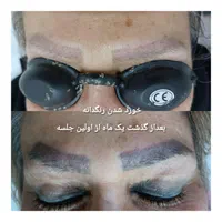 پاک کردن تتو با لیزر کیوسوئیچ|خدمات آرایشگری و زیبایی|کرج, گوهردشت|دیوار