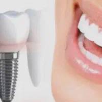 جشنواره ایمپلنت تخصصی فقط درلبخند فرتاک