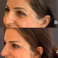 تخفیف پاییزی بوتاکس کلینیک زیبایی|خدمات آرایشگری و زیبایی|اردبیل, |دیوار